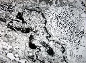 M, 40y. | unclassified skin inflammation … alterated collagen M, 40y. | unclassified skin inflammation … alterated collagen